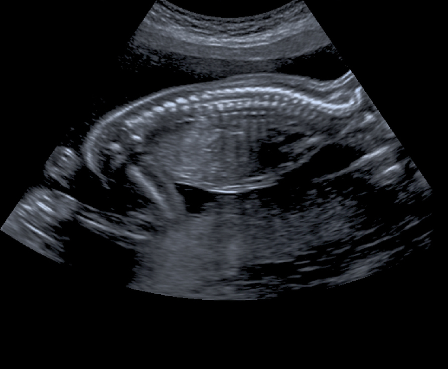 Pregnancy scan at 4 weeks